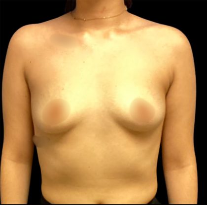 Breast Augmentation Before & After Patient #6549