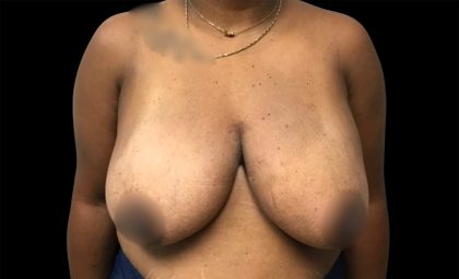 Breast Reduction Before & After Patient #6545