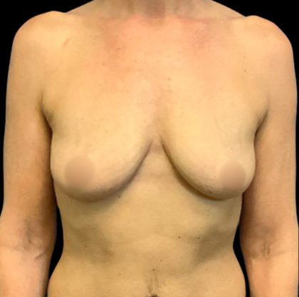 Breast Augmentation Before & After Patient #6550
