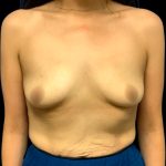 Breast Augmentation Before & After Patient #6552