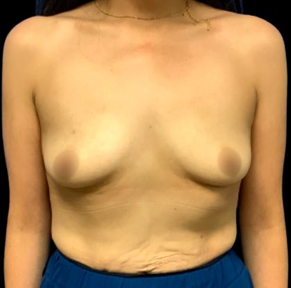 Breast Augmentation Before & After Patient #6552