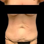 Circumferential Abdomen Before & After Patient #6553