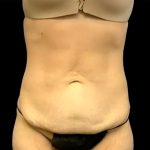Circumferential Abdomen Before & After Patient #6554