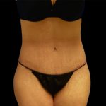 Circumferential Abdomen Before & After Patient #6556