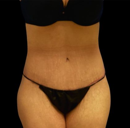 Circumferential Abdomen Before & After Patient #6556
