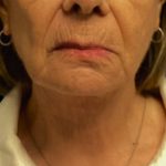 Facelift Before & After Patient #6557