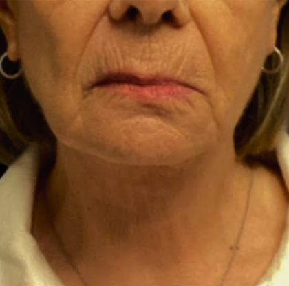 Facelift Before & After Patient #6557