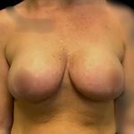Mastopexy Augmentation Before & After Patient #6558