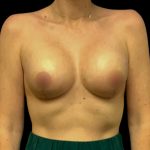 Mastopexy Augmentation Before & After Patient #6559