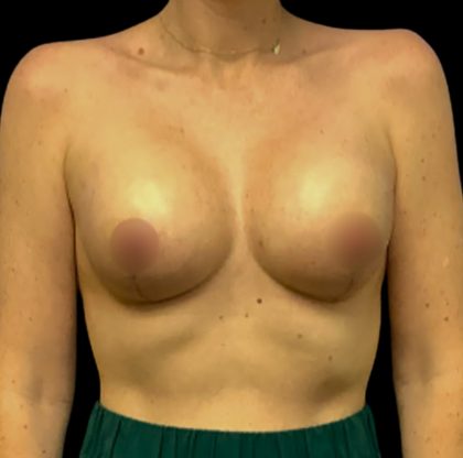 Mastopexy Augmentation Before & After Patient #6559