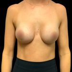 Mastopexy Augmentation Before & After Patient #6563