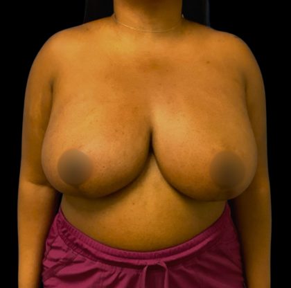 Breast Reduction Before & After Patient #6565