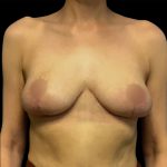 Breast Reduction Before & After Patient #6566