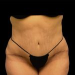 Tummy Tuck Before & After Patient #6567
