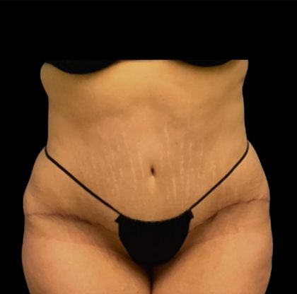 Tummy Tuck Before & After Patient #6567