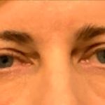 Blepharoplasty Before & After Patient #6569