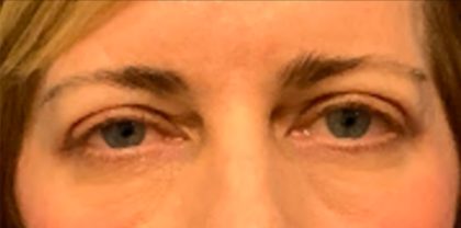 Blepharoplasty Before & After Patient #6569