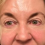 Blepharoplasty Before & After Patient #6570