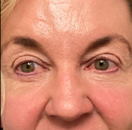 Blepharoplasty Before & After Patient #6570