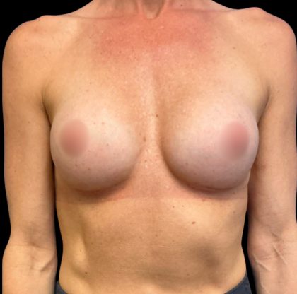 Breast Augmentation Before & After Patient #6572