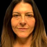 Facelift Before & After Patient #6573