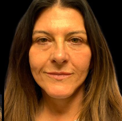Facelift Before & After Patient #6573