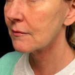 Facelift Before & After Patient #6574