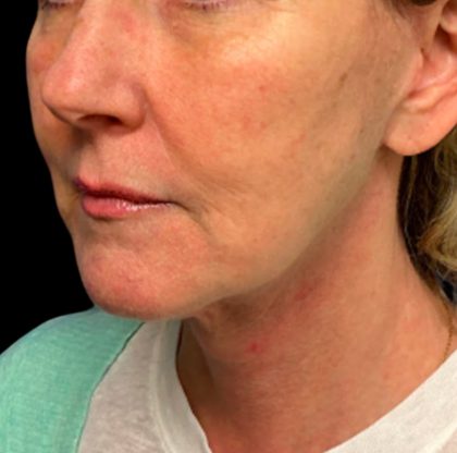 Facelift Before & After Patient #6574