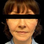 Facelift Before & After Patient #6575