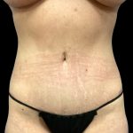 Liposuction Before & After Patient #6577