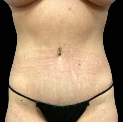 Liposuction Before & After Patient #6577