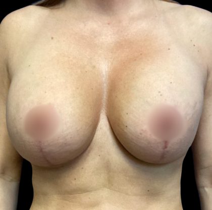 Implant Removal Before & After Patient #6578