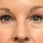 Blepharoplasty Before & After Patient #6579