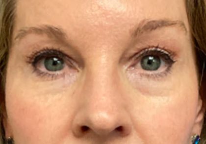Blepharoplasty Before & After Patient #6579