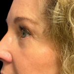 Blepharoplasty Before & After Patient #6580