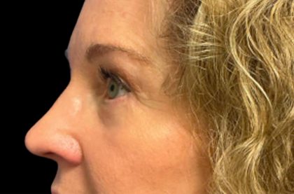 Blepharoplasty Before & After Patient #6580