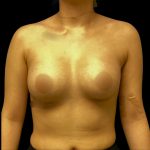 Breast Augmentation Before & After Patient #6549