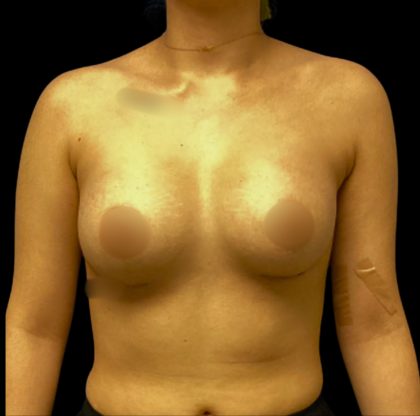 Breast Augmentation Before & After Patient #6549