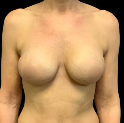 Breast Augmentation Before & After Patient #6550