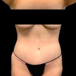 Circumferential Abdomen Before & After Patient #6553