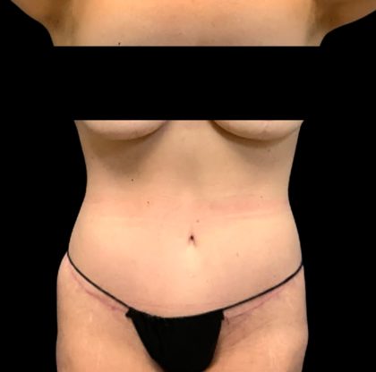 Circumferential Abdomen Before & After Patient #6553