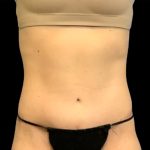 Circumferential Abdomen Before & After Patient #6554
