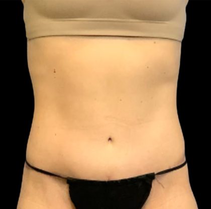 Circumferential Abdomen Before & After Patient #6554