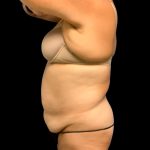 Tummy Tuck Before & After Patient #6546