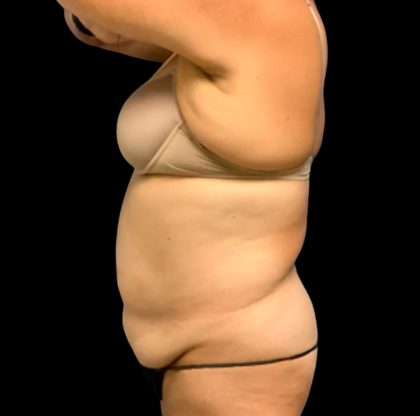 Tummy Tuck Before & After Patient #6546