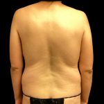 Circumferential Abdomen Before & After Patient #6555