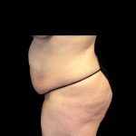Circumferential Abdomen Before & After Patient #6556