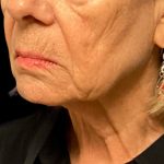Facelift Before & After Patient #6557