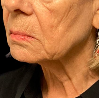 Facelift Before & After Patient #6557
