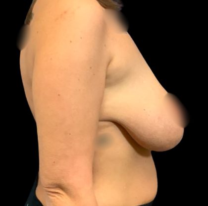 Mastopexy Augmentation Before & After Patient #6558